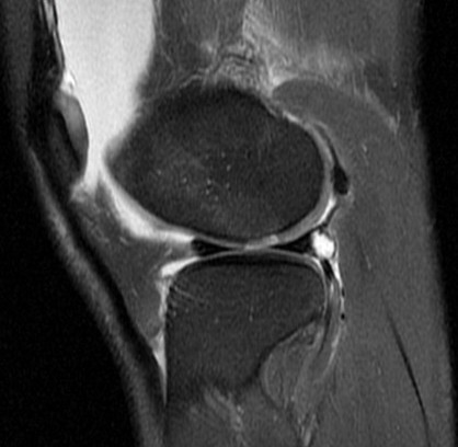 Figure 3 for case Patellar dislocation